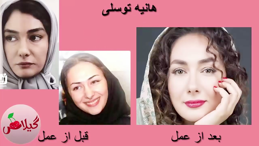 هانیه توسلی قبل و بعد از عمل زیبایی